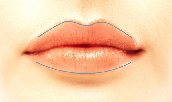 Aufspritzen der Lippenlinie/Lippenkontur mit Hyaluronsäure