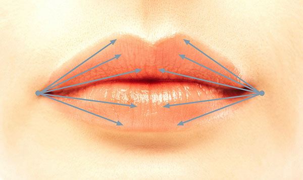 Lippenaufspritzen durch Fächertechnik mit der Mikrokanüle