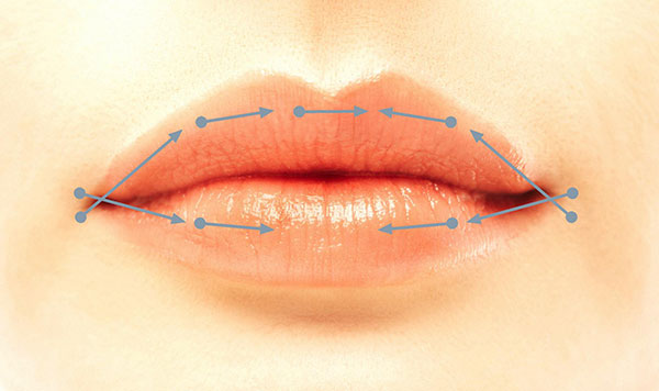 Longitudinale Lippenaufspritztechnik
